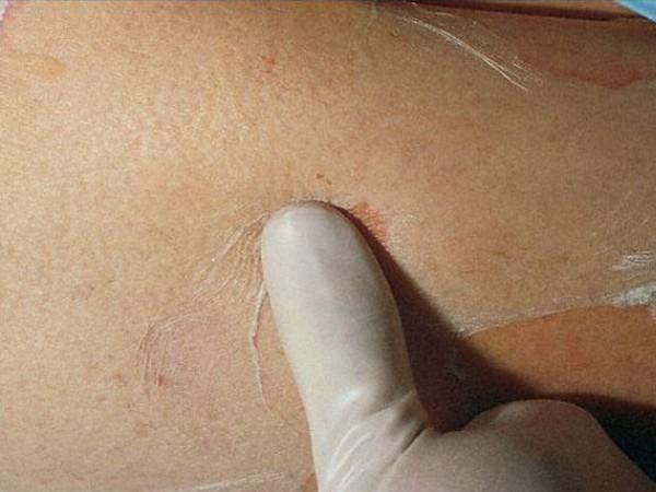 Αναφέρεται ένα πρόδρομο στάδιο προσομοιάζον με ιογενή συνδρομή, εμπύρετο Ερυθηματώδεις ή πορφυρικές κηλίδες, ενώνονται, δημιουργούνται