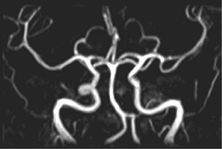 Σπονδυλική αρτηρία Έσω καρωτίδα Κοινή καρωτίδα Πρόσθια εγκεφαλική αρτηρία Υποκλείδια αρτηρία Θωρακική αορτή