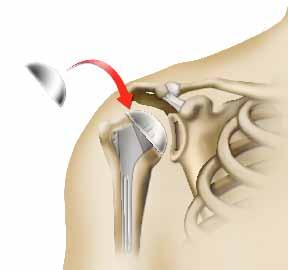 Η επέμβαση που σας προτείνουν Η βασική επέμβαση Ο χειρουργός αφαιρεί το ανώτερο τμήμα του οστού του βραχίονα (κεφαλή βραχιονίου) και κόβει το οστό, βάσει υπολογισμών, ανάλογα με το είδος της πρόθεσης