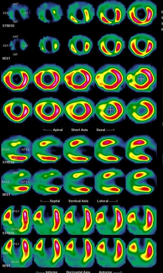 ΜΚΔ ΜΚΔ SPECT ΑΙΜΑΤΩΣΕΩΣ ΤΟΥ