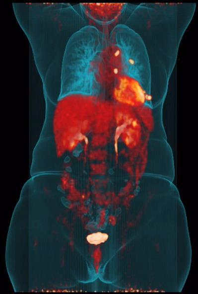 FDG-PET/CT στην Ογκολογία Το FDG PET/CT δεν είναι κατάλληλο για όλες τις κακοήθειες. Π.χ.