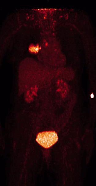 FDG-PET/CT σε αρχική σταδιοποίηση