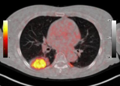 πνεύμονα (NSCLC) στη φάση της