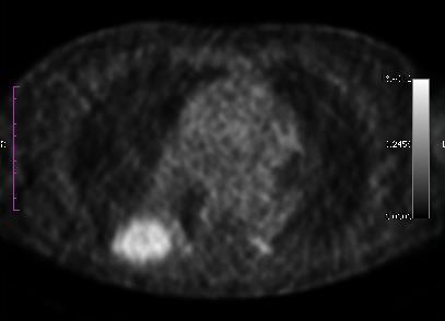 Στο PET/CT αναδεικνύεται μετάσταση