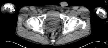 FDG-PET/CT στον έλεγχο της