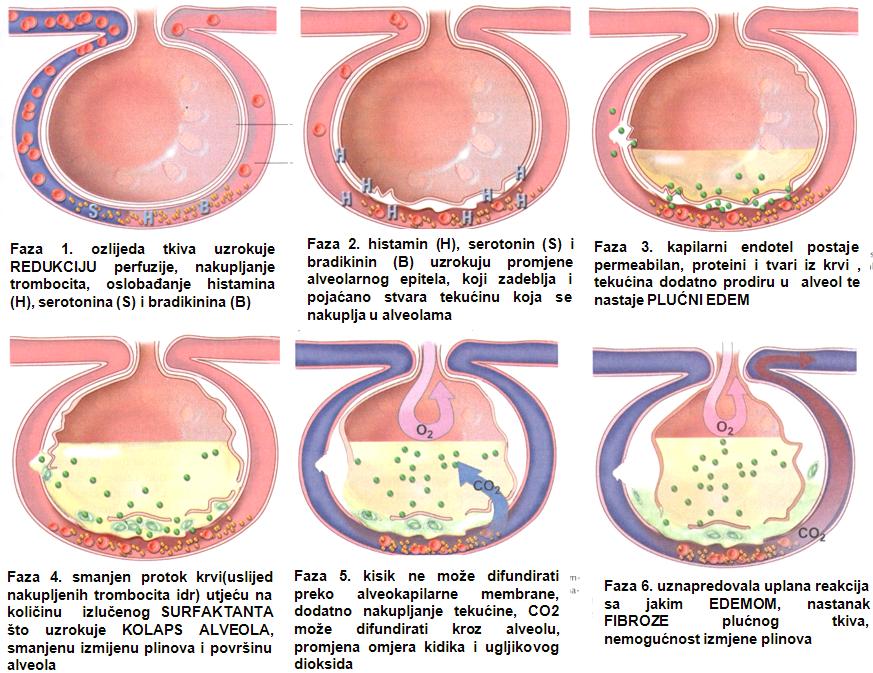 EMFIZEM plućni- promjena u volumenu alveolarne vrećice uz istovremeni gubitak elasticitieta alveola.