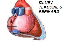 III. POREMEĆAJI U KARDIOVASKULARNOM SUSTAVU: A) srca; B) krvnih žila-hipertenzija, hipotenzija A) POREMEĆAJI SRCA POREMEĆAJI PUNJENJA SRCA zbog: BOLESTI PERIKARDA BOLESTI MIOKARDA FUNKCIJE SRČANIH