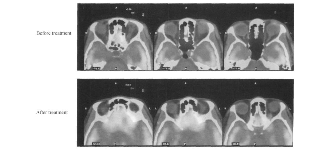 914 J Exp Hematol 2012 20 4 PR 5 R + CHOP 6 PET-CT Ⅳ 4 R + CHOP 8 1 79 CR 2 1 2 Table 2.