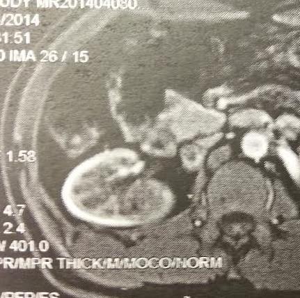 Άνδρας 36 ετών με μακροσκοπικη αιματουρία Στις 08/04/2014 έγινε MRI, η οποία