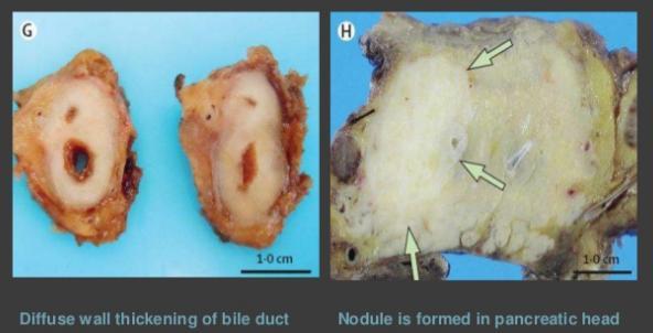 Mahajan VS et al Annu Rev Pathol.