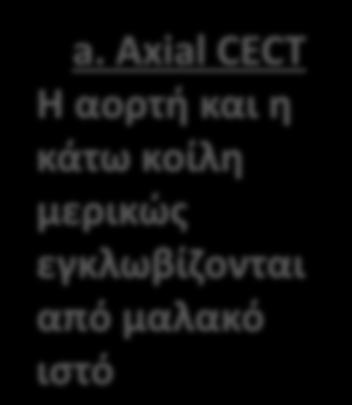 κοίλη μερικώς εγκλωβίζονται από