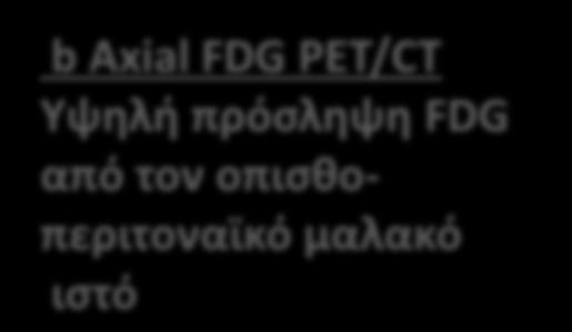 Axial CECT Μετά θεραπεία με