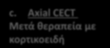 T1FS postcontrast MRI Μετά