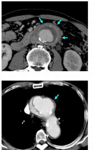 IgG4 αορτίτιδα Contrast-enhanced CT