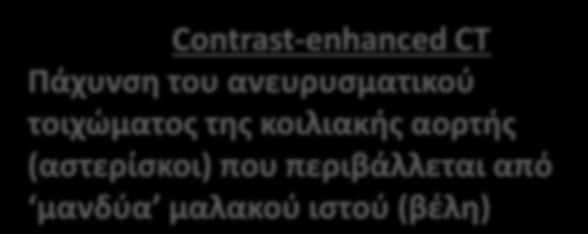 (βέλη) * * CT θωρακικής αορτής