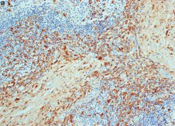 Vikram Deshpande et al Modern Pathology (2012) 25, 1181 1192 Sato Y et al J Clin