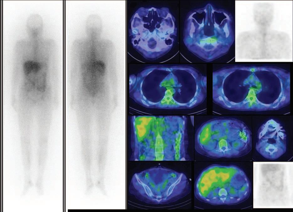 SPECT/CT Gallium single-photon emission computed tomography/ computed tomography Γυναίκα, 32 ετών με διαλείπον ανώδυνο