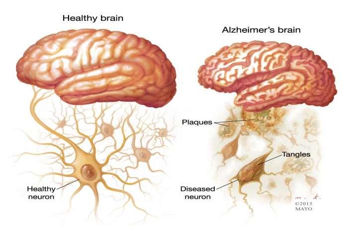 Atrofia mozgu - hipokampu a mozgovej kôry