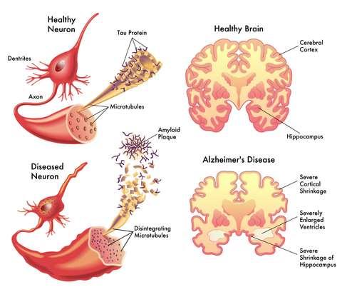 ß Amyloid tvorí extracelulárne plaky 2 formy - kratšia 40 končí valínom - dlhšia 42 končí alanínom ßA 42 väčšia klinická