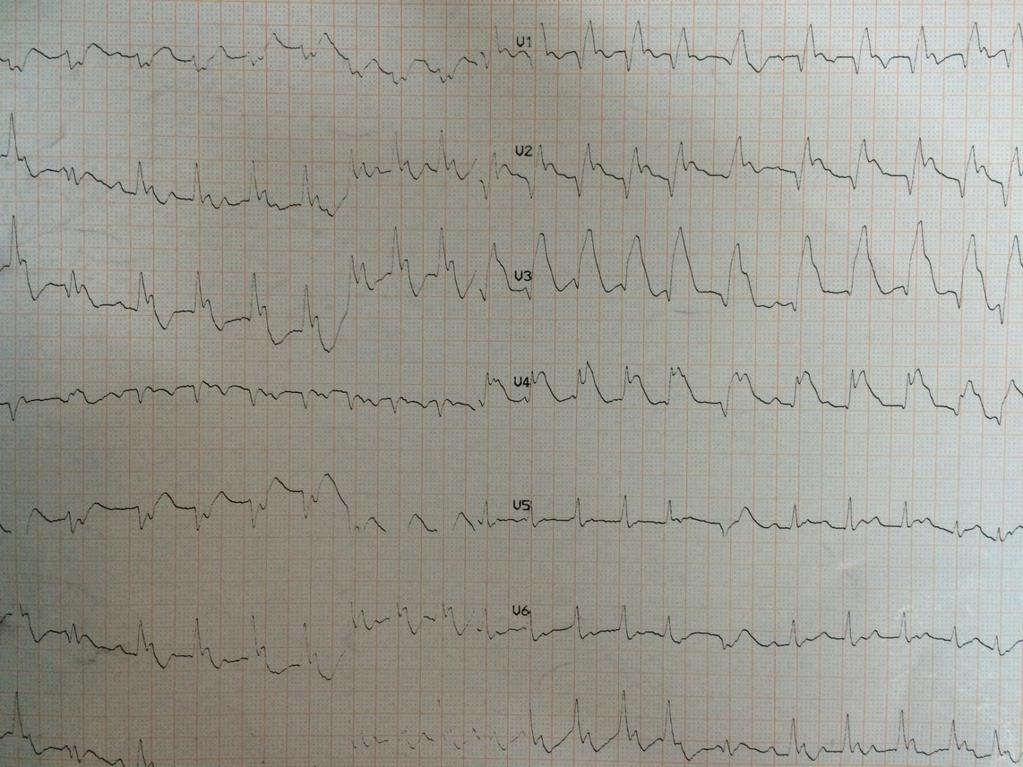 ECG
