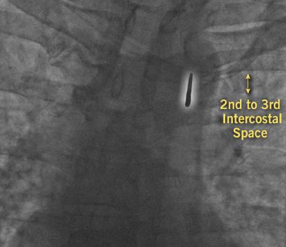 subclavian artery -