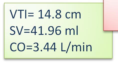 HR = 82 bpm LVOT d = 1.