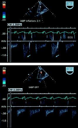 Transesophageal Doppler echocardiography during mechanical assist circulation.