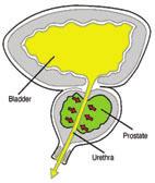 retention and surgery with finasteride for 6 years in men with benign prostatic hyperplasia. J Urol. 2004; 171:1194-8. 14. Kaplan SA, Roehrborn CG, McConnell JD, et al.