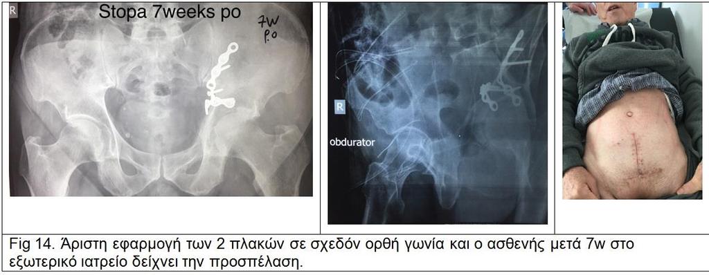227 πτέρυγα (Fig.15) με διακαταγματική επίσης βίδα προς συγκράτηση της πτέρυγας επιφάνειας. Στην 3η περίπτωση η πλάκα δεν εφαρμόστηκε σωστά (Fig. 16).