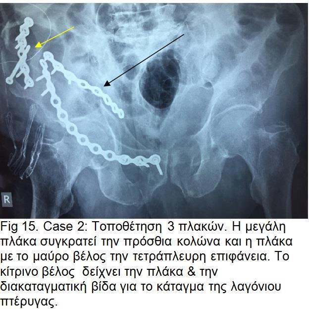 Αυτό επιβεβαιώθηκε με μετεγχειρητική αξονική τομογραφία όπου παρατηρήσαμε την μερική συγκράτηση του κατάγματος.