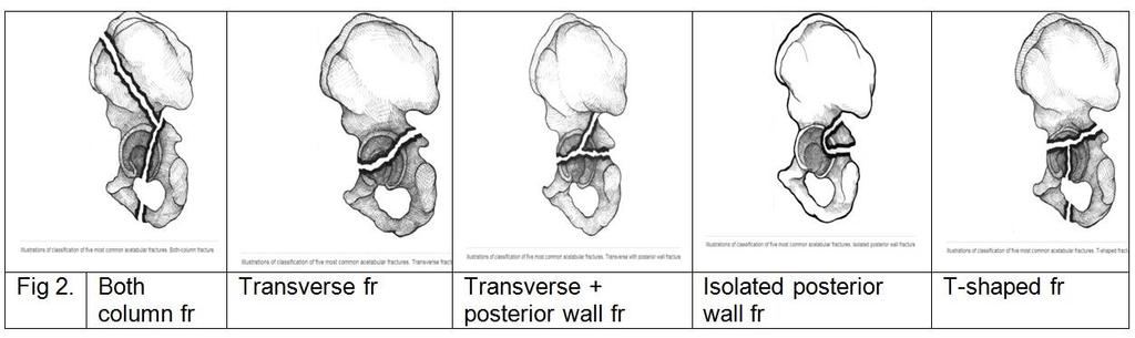 (Transverse), τα εγκάρσια με οπίσθιο τοίχωμα κοτύλης (Transverse+posterior wall fr), τα μεμονωμένα του οπισθίου τοιχώματος κοτύλης (Isolated posterior wall fr), και τα σχήματος «Τ» (T-shaped)