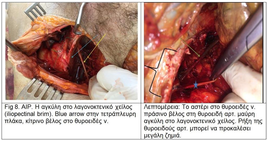 Μερικές λεπτομέρειες της ανατομίας της περιοχής του απεικονίζονται στην Fig 8 κατά την