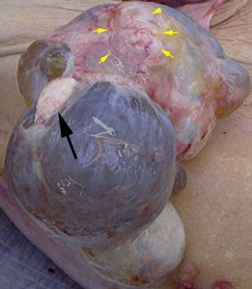 Biológia rakoviny, Vanda Repiská Obr. 8 Zhubný nádor vaječníka (žlté šípky) pozostávajúci z viacerých dutín vyplnených čírou tekutinou.. Zvyšky vaječníka (čierna šípka). (foto : MUDr.