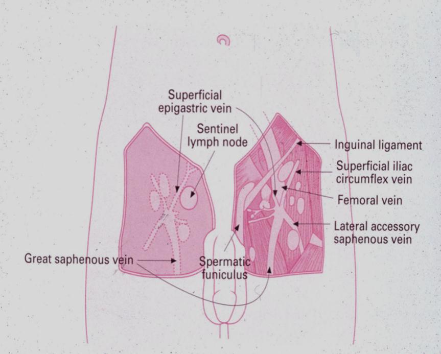 DSNB vs ILND DSNB Minimally invasive Σταδιοποίηση Επιλογή ασθενών για ILND Μείωση νοσηρότητας & επιπλοκών 1-2 ημέρες νοσηλείας Επιτρέπει την αποφυγή του