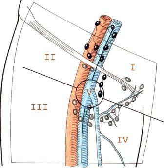 Τοπογραφία βουβωνικών ΛΜΔ Daseler zones I II III IV V Superomedial nodes