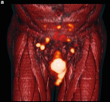 CT/PET scan Sensitivity 80%