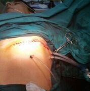 Case report # 2 A 34 year old male prisoner was admitted to the emergency department of Nafplion General Hospital after fighting and being injured by a knife on the left chest bellow the left nipple,