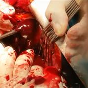 He was rapidly transferred to the operating room for resuscitative thoracotomy. After pericardiotomy through a left anterolateral incision, a wound at the right ventricle was recognized.