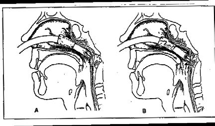 Η κοιλότητα του φάρυγγα, ανάλογα με τη σχέση της με τα γειτονικά όργανα, διαιρείται σε τρεις αλληλοδιάδοχες μοίρες, τον ρινοφάρυγγα ή επιφάρυγγα, τον στοματοφάρυγγα και τον υποφάρυγγα (Εικόνα 6).