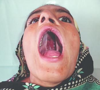 com/2016/08/10/58-majorreconstructive-surgery-following-excisionof-malignant-tumors-of-the-head-face-andthe-neck-the-indian-experience/treatment Εικόνα 8. Υπερωιοσχιστία.Fayyaz G, et al(2015).
