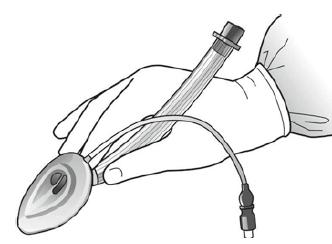 Ακολουθεί κράτημα της συσκευής με το ισχυρό χέρι σαν μολύβι, τοποθετώντας το δείκτη μας στο σημείο μετάβασης του σωλήνα στον αεροθάλαμο (Εικόνα 24).