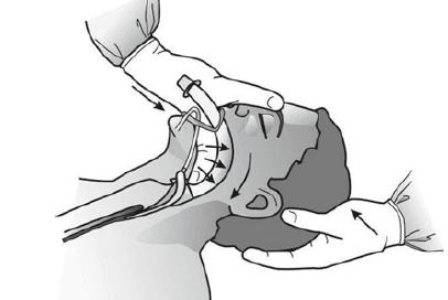 σκληράς υπερώας (με κατεύθυνση προς τα πίσω), ασκώντας πίεση με το δείκτη του ισχυρού χεριού επί της υπερώας (Εικόνα 25).