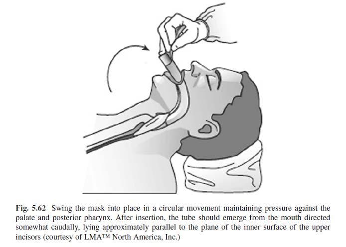 Πιάσιμο χειρολαβής και εισαγωγή της LMA Fastrach TM εντός της στοματικής κοιλότητας : πιάνοντας τη μάσκα από τη μεταλλική λαβή, εισάγουμε την άκρη της στη στοματική κοιλότητα, ώστε το άκρο του