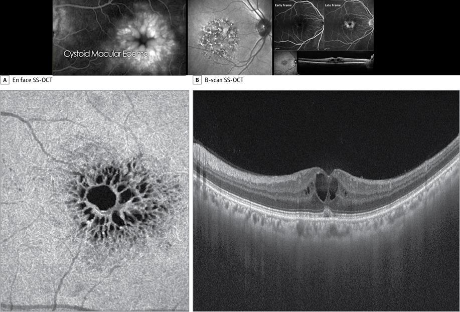 Cystoid Macular Edema The pathophysiology of CME is not completely
