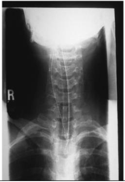 Case 5 Οι αυχενικοί σπόνδυλοι (Α3-Α7) και οι θωρακικοί (Θ1,Θ2) απεικονίζονται με ευκρίνεια.