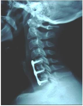 Case 25. It is a true lateral meaning that the mandibular angles are superimposed, as are all apophyseal joints.