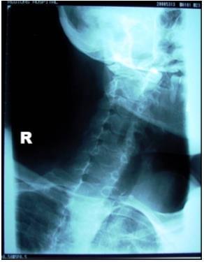 Case 26 This is a PA oblique view with the patient positioned in RAO. The CR is angled 15-degrees caudal to open the intervertebral joints. Notice that the intervertebral joints are not opened well.