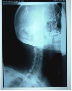 Case 27 This is a relatively good radiograph that unfortunately will need to be repeated. The six required intervertebral foramina and vertebrae C7 through T1 are not entirely demonstrated.