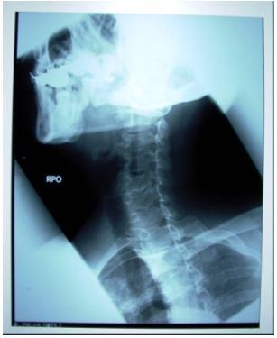 Case 28 All six required intervertebral foramina are seen on this radiograph; however, they are not opened as well as they can be. The posterior arch of C1 is not well visualized.