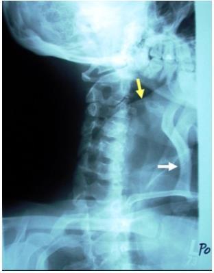 It looks like the technologist had the patient hold on to an I.V pole or the upright bucky to maintain balance.